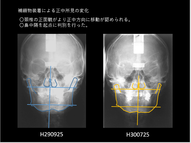 咬合は物理的刺激と言えるだろうし、顎位も物理的存在と言えるだろうし。炎症は厄介だっていう話の収め。