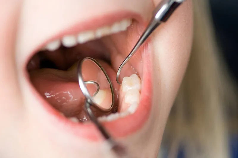 虫歯の再発を予防するメンテナンス