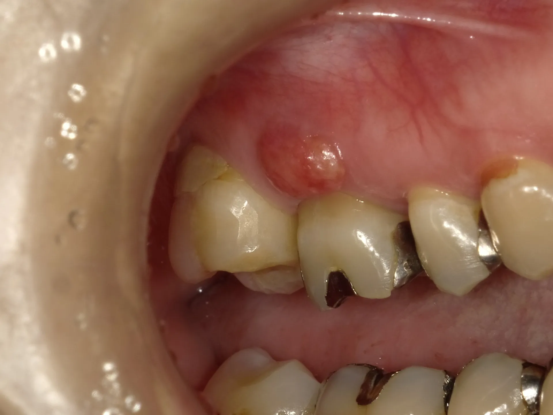 歯肉の腫れは、歯根膜からになるのか？